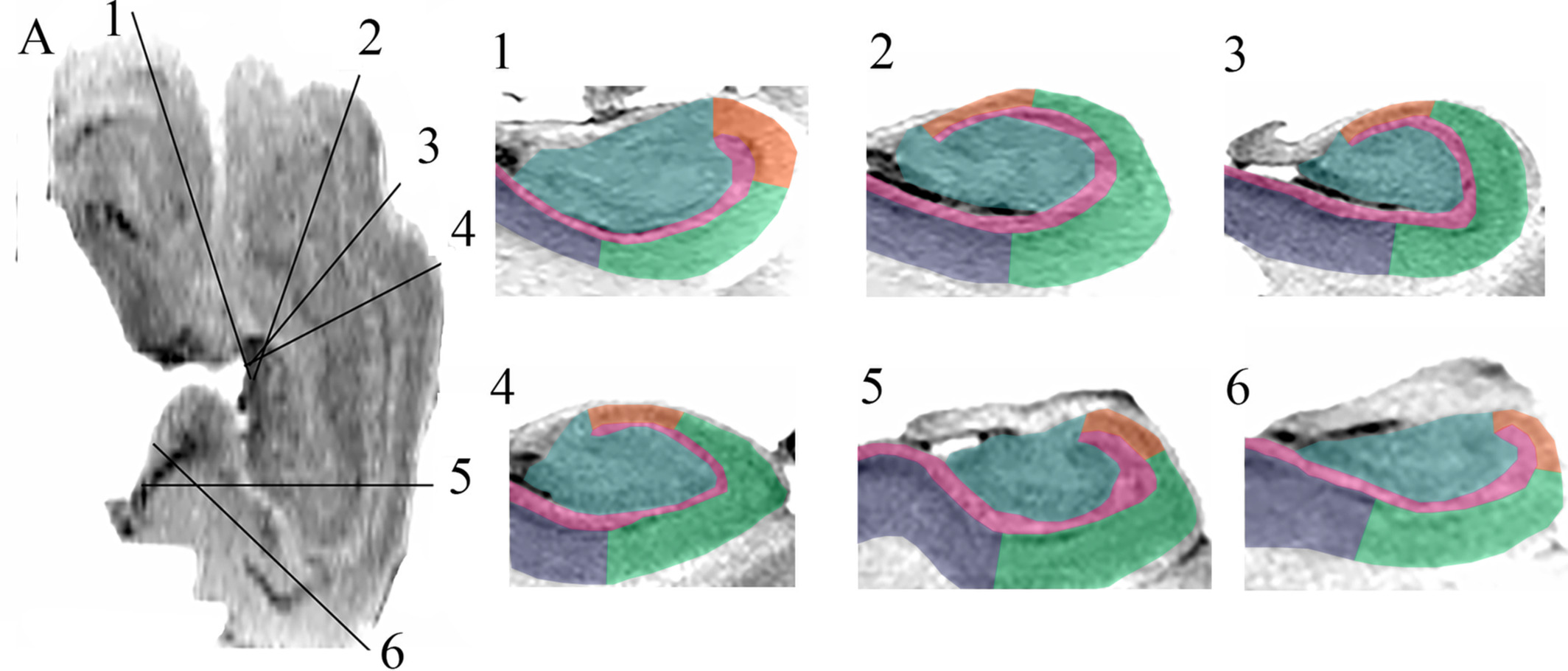 Figure for Curved Multiplanar Reformatting Provides Improved Visualization of Hippocampal Anatomy.