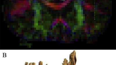 White Matter Tractography of the Neural Network for Speech-Motor Control in Children Who Stutter. featured image