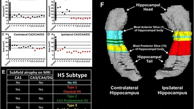 Hippocampal Subfield Measurement and ILAE Hippocampal Sclerosis Subtype Classification with in Vivo 4.7 Tesla MRI. featured image